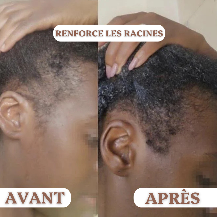 SanaHair™⎪Repousse Capillaire Au Batana